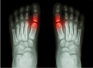 Gout – Causes, Symptoms and Treatments